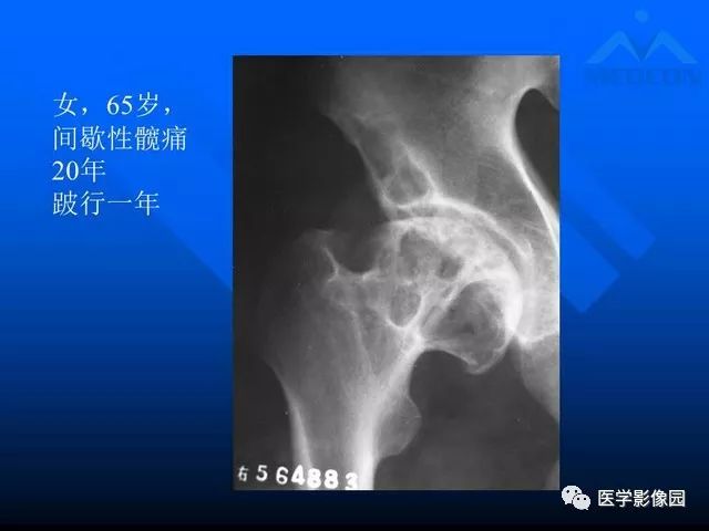 【PPT】关节周围那些囊状骨破坏的诊断与鉴别