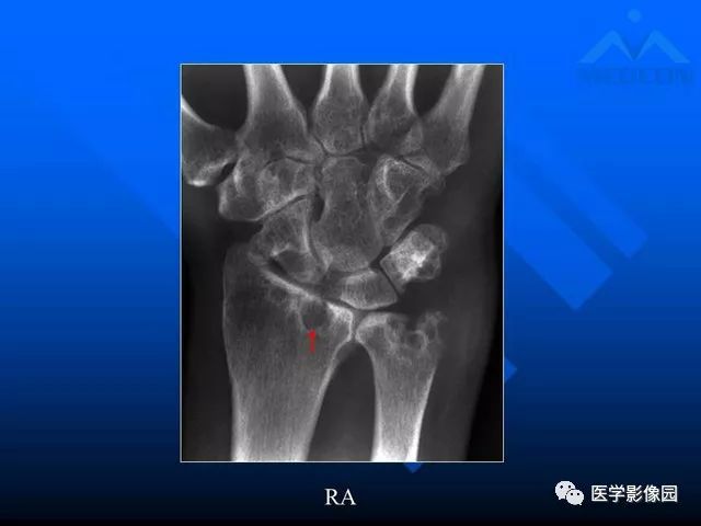 【PPT】关节周围那些囊状骨破坏的诊断与鉴别