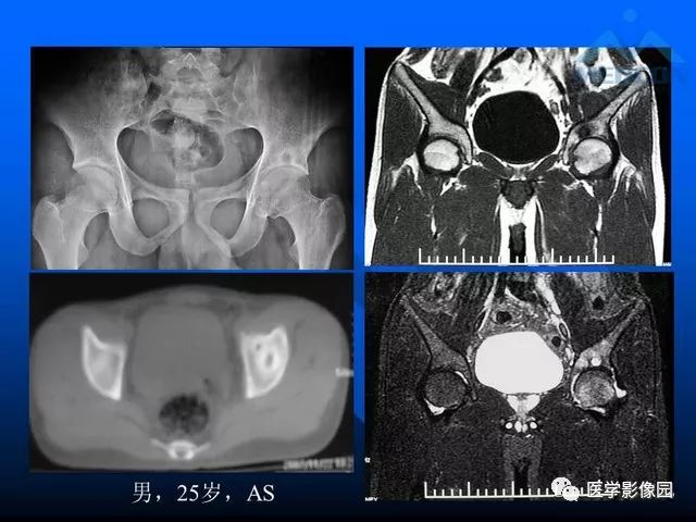 【PPT】关节周围那些囊状骨破坏的诊断与鉴别