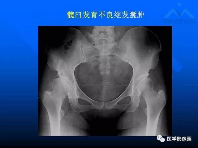 【PPT】关节周围那些囊状骨破坏的诊断与鉴别