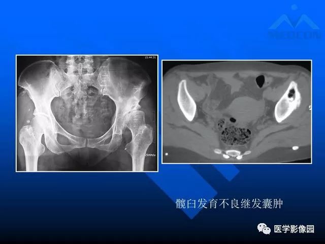 【PPT】关节周围那些囊状骨破坏的诊断与鉴别