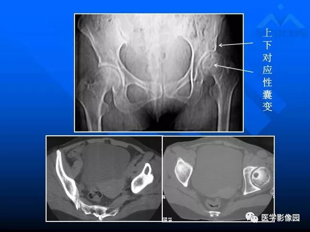 【PPT】关节周围那些囊状骨破坏的诊断与鉴别