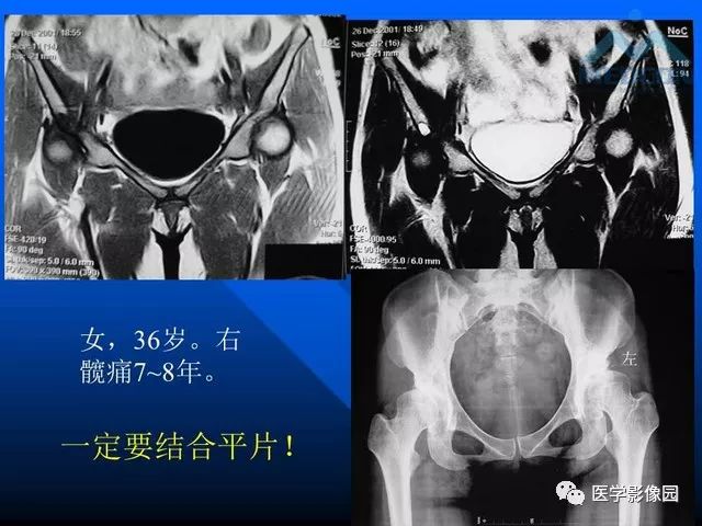 【PPT】关节周围那些囊状骨破坏的诊断与鉴别