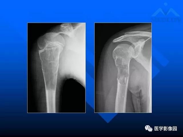 【PPT】关节周围那些囊状骨破坏的诊断与鉴别