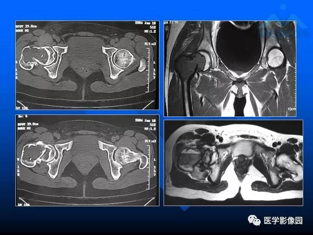 【PPT】关节周围那些囊状骨破坏的诊断与鉴别