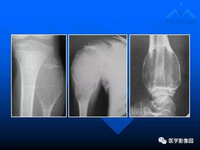 【PPT】关节周围那些囊状骨破坏的诊断与鉴别