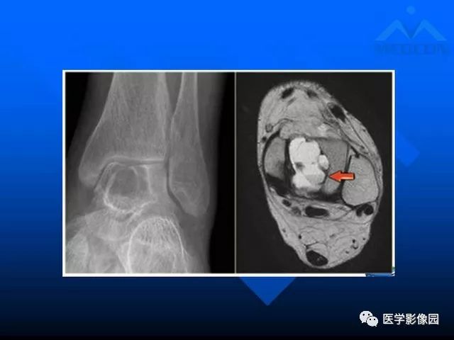 【PPT】关节周围那些囊状骨破坏的诊断与鉴别