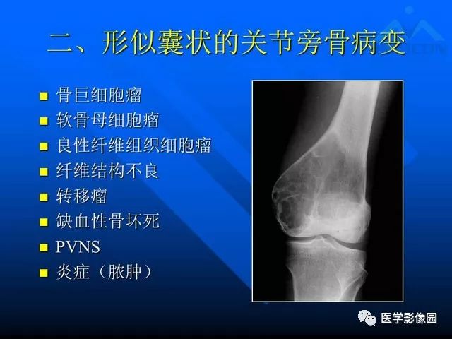 【PPT】关节周围那些囊状骨破坏的诊断与鉴别