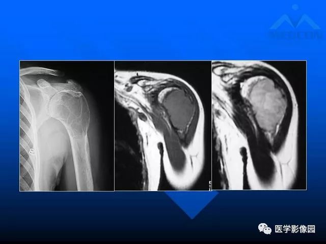 【PPT】关节周围那些囊状骨破坏的诊断与鉴别