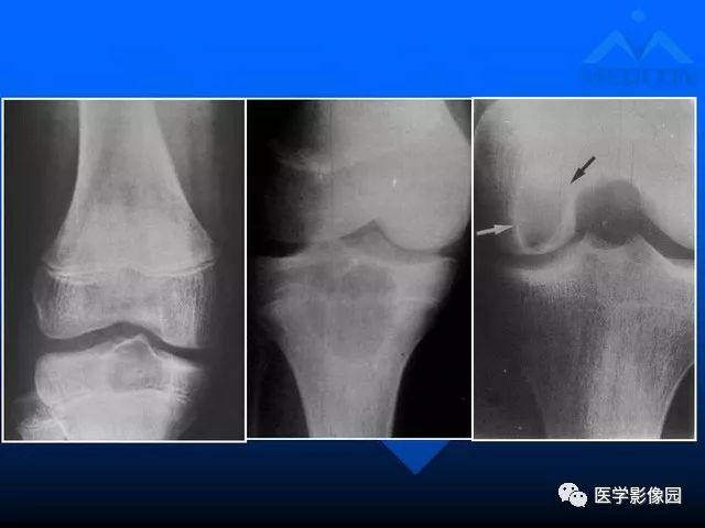 【PPT】关节周围那些囊状骨破坏的诊断与鉴别