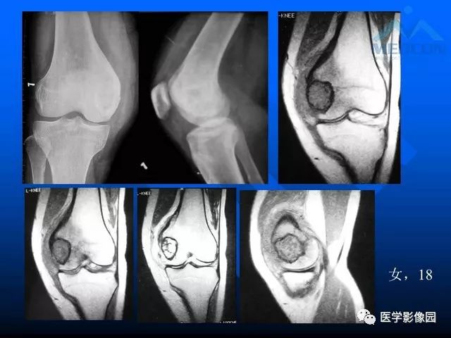 【PPT】关节周围那些囊状骨破坏的诊断与鉴别
