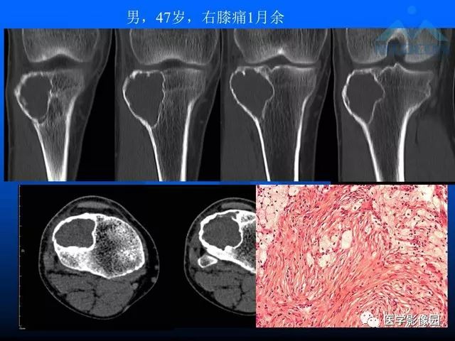 【PPT】关节周围那些囊状骨破坏的诊断与鉴别