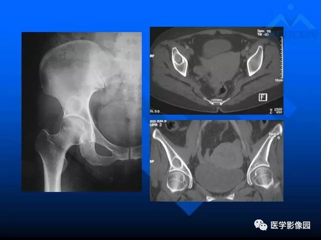 【PPT】关节周围那些囊状骨破坏的诊断与鉴别