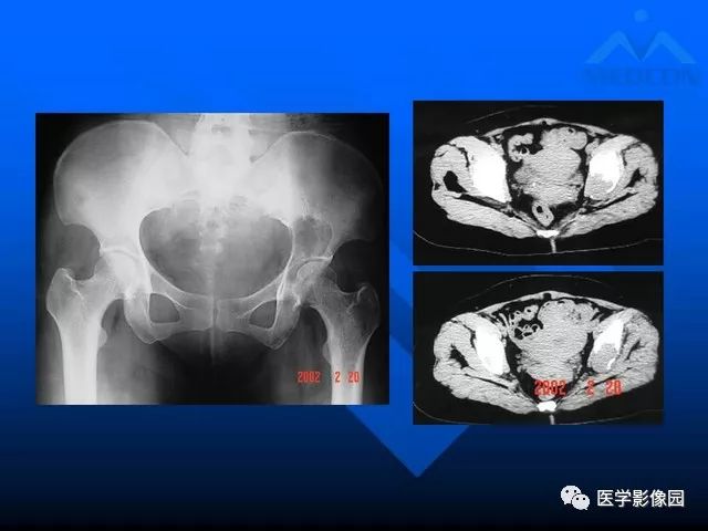 【PPT】关节周围那些囊状骨破坏的诊断与鉴别