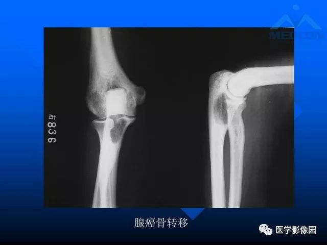 【PPT】关节周围那些囊状骨破坏的诊断与鉴别