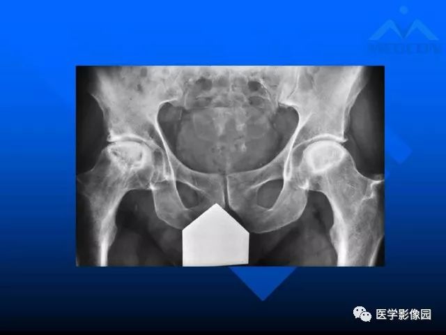 【PPT】关节周围那些囊状骨破坏的诊断与鉴别