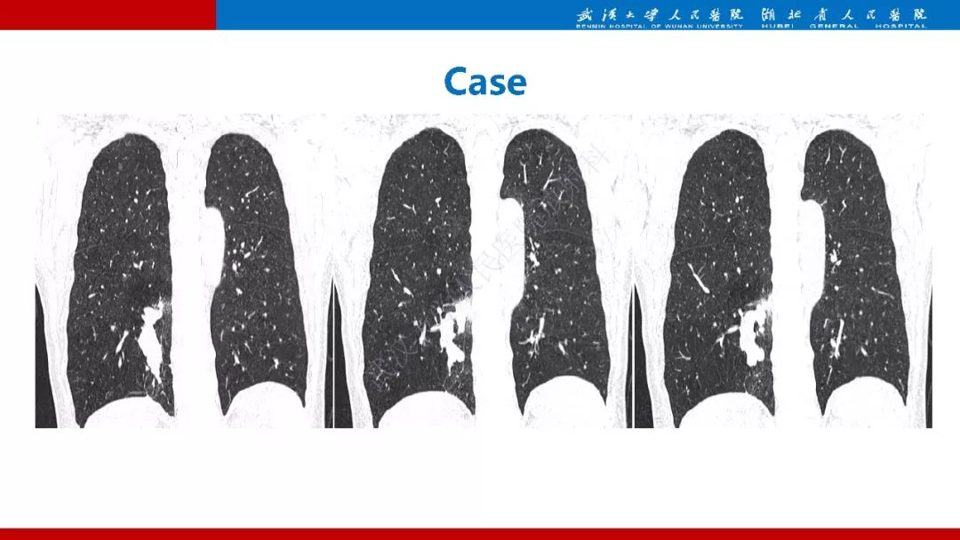 【PPT】先天性支气管闭锁影像诊断