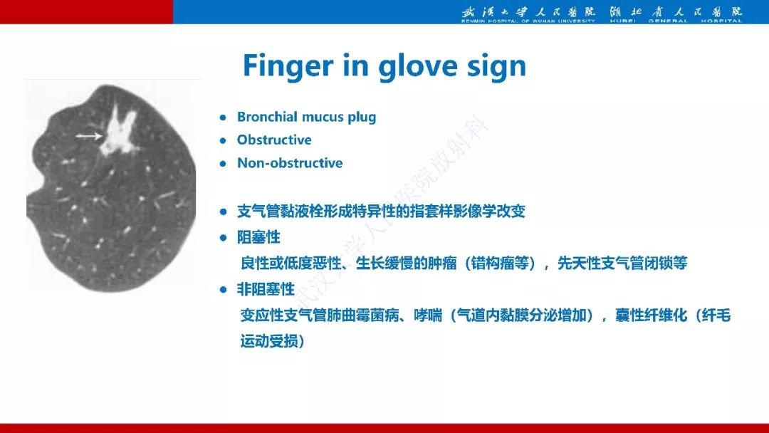【PPT】先天性支气管闭锁影像诊断