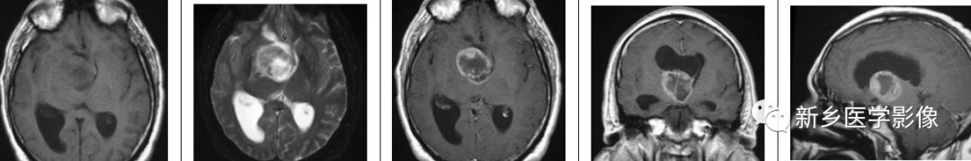 鞍上14种强化肿块汇总