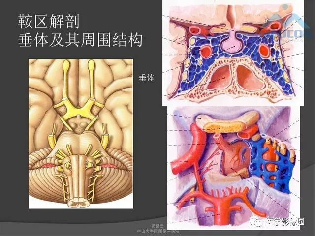 【PPT】鞍区肿瘤与颅神经
