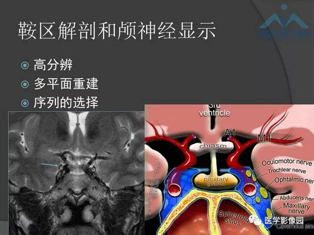 【PPT】鞍区肿瘤与颅神经