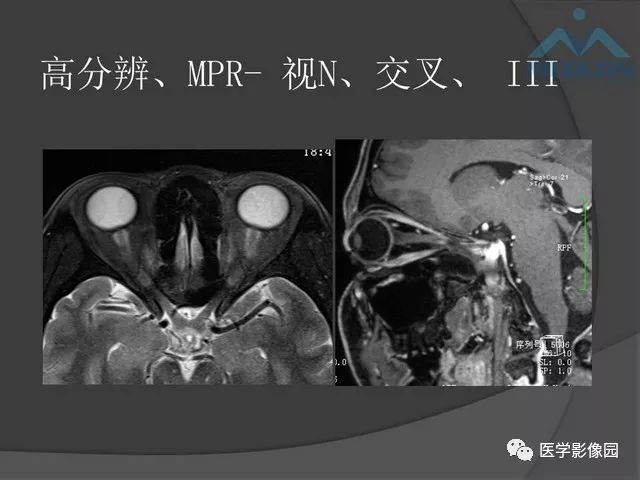 【PPT】鞍区肿瘤与颅神经
