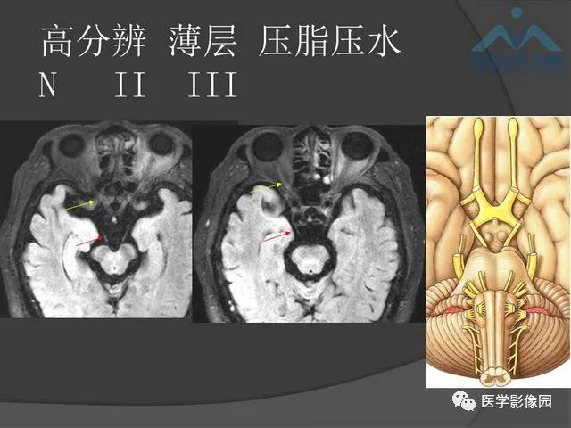 【PPT】鞍区肿瘤与颅神经