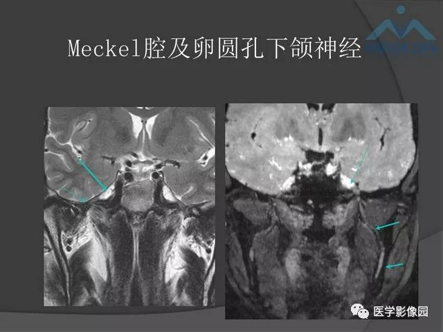 【PPT】鞍区肿瘤与颅神经
