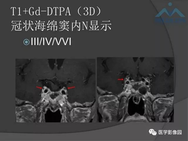 【PPT】鞍区肿瘤与颅神经