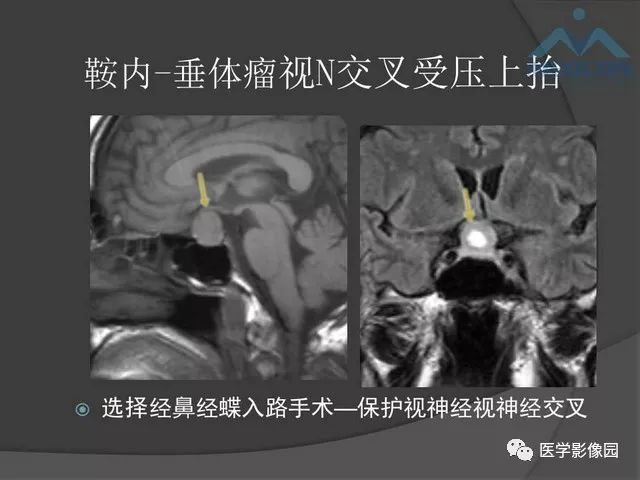 【PPT】鞍区肿瘤与颅神经