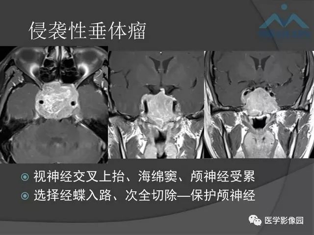 【PPT】鞍区肿瘤与颅神经