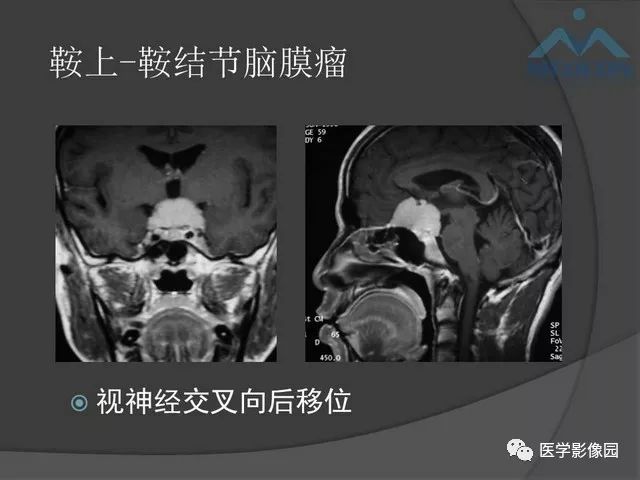 【PPT】鞍区肿瘤与颅神经