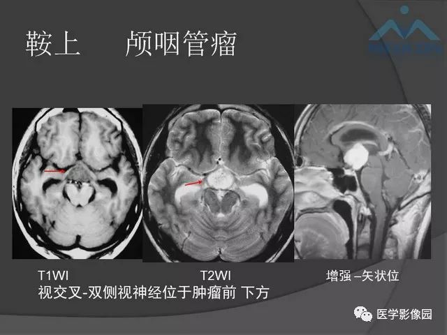 【PPT】鞍区肿瘤与颅神经