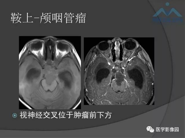 【PPT】鞍区肿瘤与颅神经