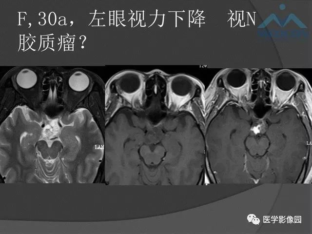 【PPT】鞍区肿瘤与颅神经