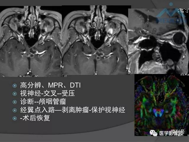 【PPT】鞍区肿瘤与颅神经