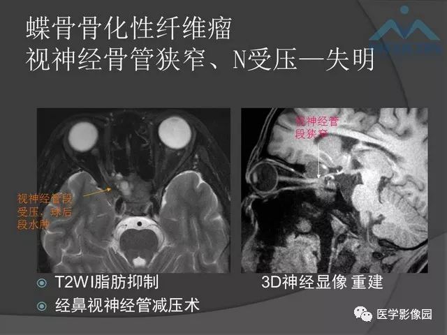 【PPT】鞍区肿瘤与颅神经