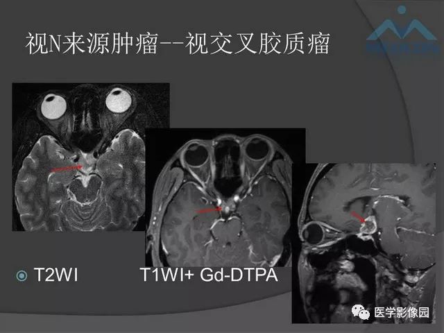 【PPT】鞍区肿瘤与颅神经