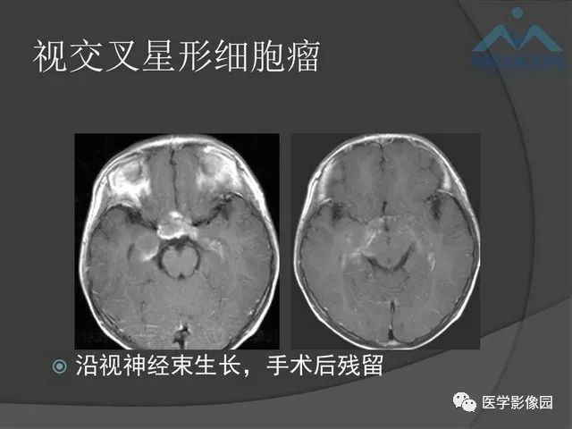 【PPT】鞍区肿瘤与颅神经