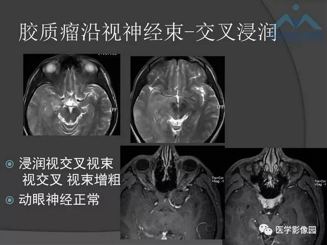 【PPT】鞍区肿瘤与颅神经