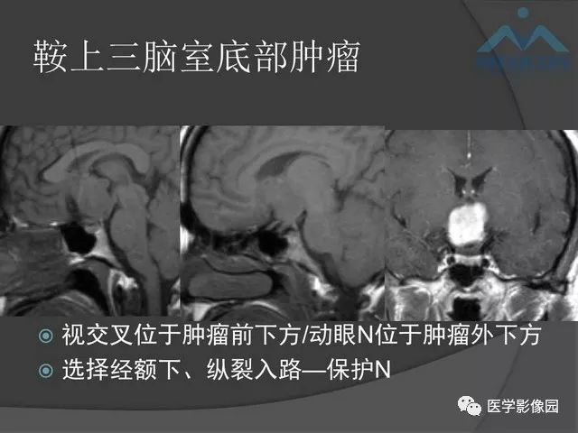 【PPT】鞍区肿瘤与颅神经