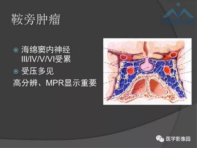 【PPT】鞍区肿瘤与颅神经
