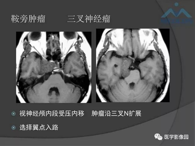 【PPT】鞍区肿瘤与颅神经