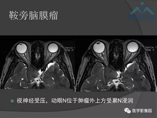 【PPT】鞍区肿瘤与颅神经