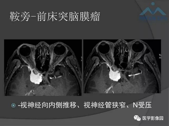 【PPT】鞍区肿瘤与颅神经