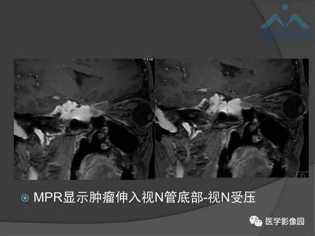 【PPT】鞍区肿瘤与颅神经