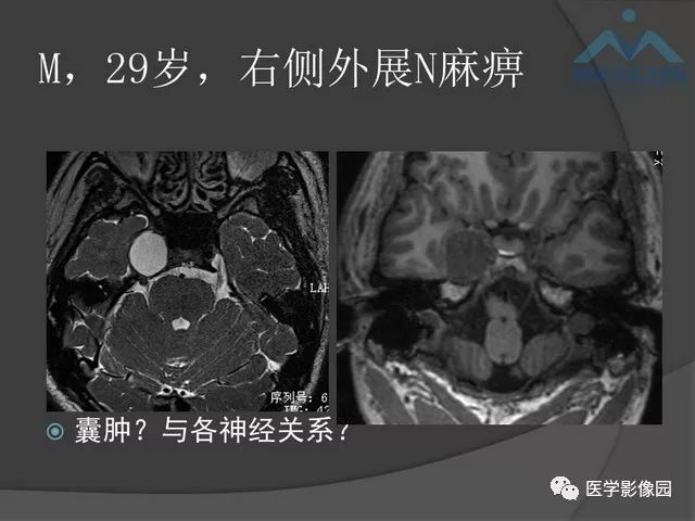 【PPT】鞍区肿瘤与颅神经