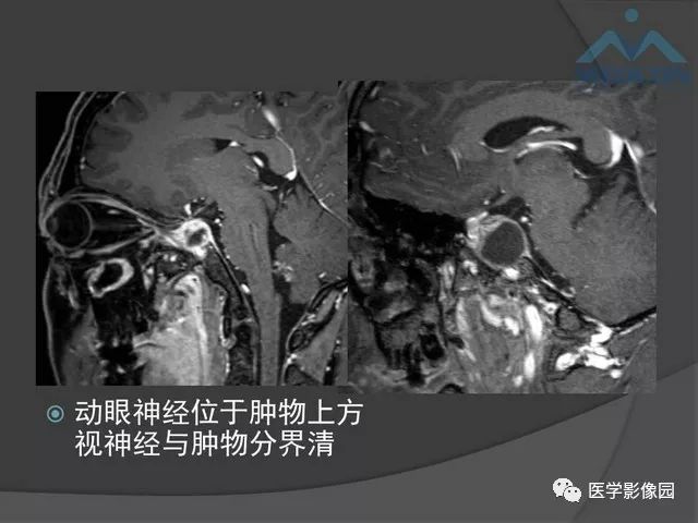 【PPT】鞍区肿瘤与颅神经
