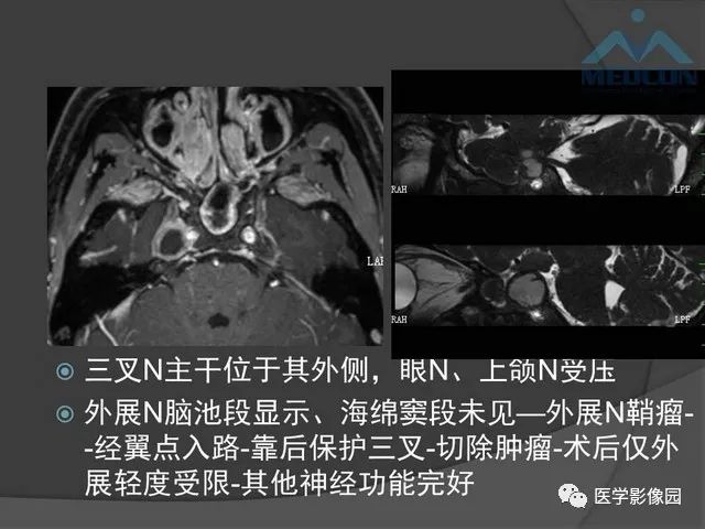 【PPT】鞍区肿瘤与颅神经