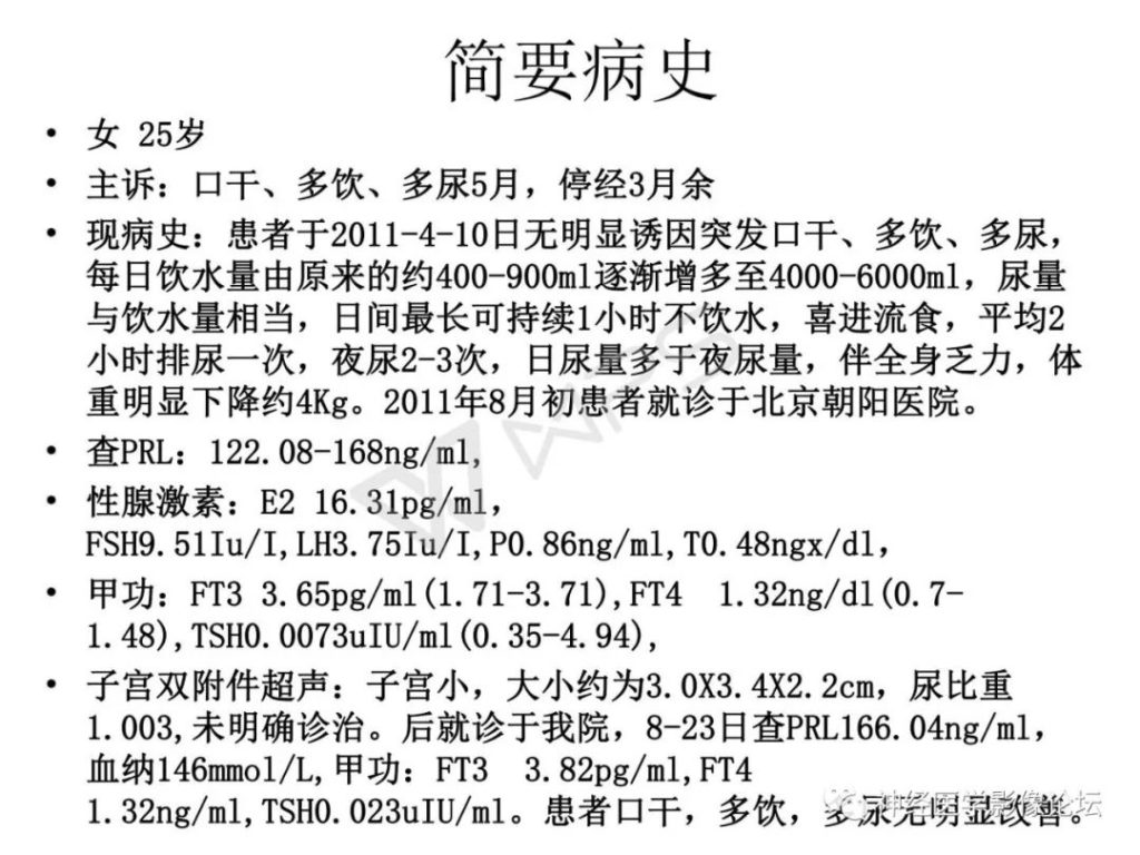【病例】下丘脑节细胞胶质瘤一例MR影像表现
